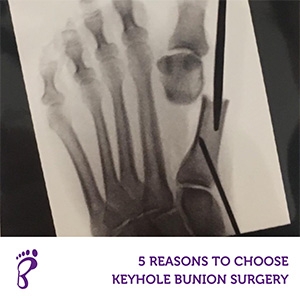 5 Reasons To Choose Keyhole Bunion Surgery