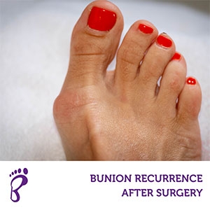 Bunion Recurrence After Surgery