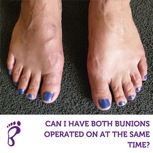 Can I have bunions on both feet operated on at the same time?