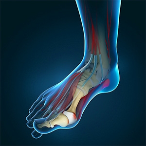 Don’t ignore your bunion