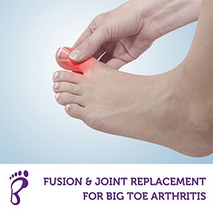 Fusion and Joint Replacement for Big Toe Arthritis