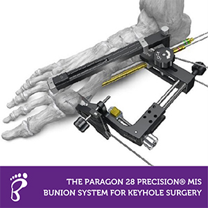The Paragon 28 PRECISION® MIS Bunion System for Keyhole Surgery