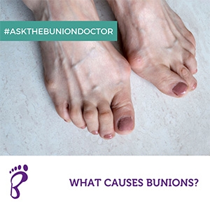 What Causes Bunions?