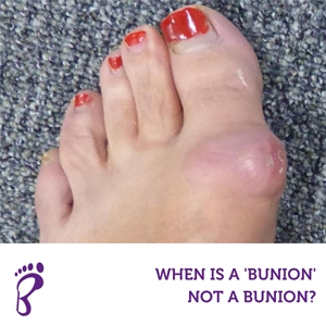When is a 'Bunion' Not a Bunion?
