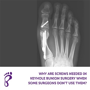 Why are screws needed in keyhole bunion surgery when some surgeons don’t use them?