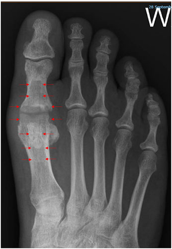 Fusion and Joint Replacementfor Big Toe Arthritis