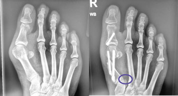 Bunion Recurrence After Surgery