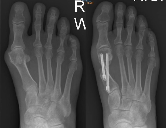 Pre and Post MICA Key Hole Bunion X-ray